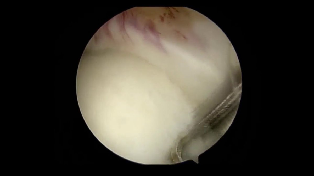 drprovencher's tweet photo. Take a look at this video of Dr. Provencher's preferred approach for treating recurrent posterior #shoulderinstability through arthroscopic #labralrepair with knotless suture anchor fixation. https://t.co/qxGKCVCcvW   #medtwitter #orthotwitter #shouldersurgery https://t.co/QxKUMnAHdR