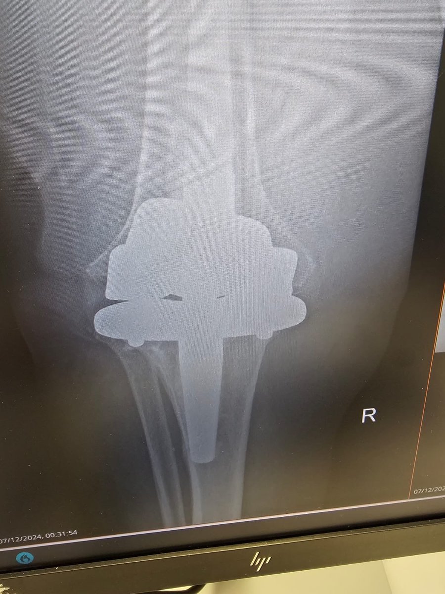 kneedoclond's tweet photo. ⁦@aschwartz45⁩ 
No Andy, I didn’t put it in, but do you know what it is…???

From a colleague and no lateral available… 😳🙄
#orthotwitter
#kneeimplants https://t.co/o3nEKdHtgb