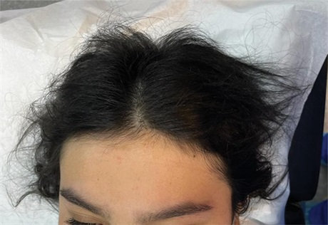 AJDP_Journal's tweet photo. #ClinicalPathologicChallenge
15YF with 2-year history of diffuse hair loss and “woolly” hair.
No h/o mental illness
No signs of inflammation or scarring
What's your diagnosis? https://t.co/o7eaLmdpdf