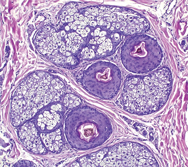 AJDP_Journal's tweet photo. #ClinicalPathologicChallenge
15YF with 2-year history of diffuse hair loss and “woolly” hair.
No h/o mental illness
No signs of inflammation or scarring
What's your diagnosis? https://t.co/o7eaLmdpdf