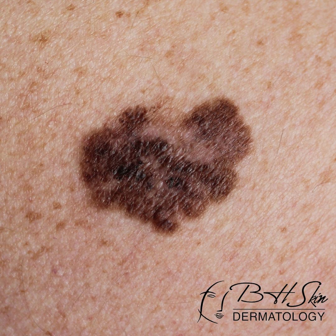 BHSkin's tweet photo. Spot the signs, protect your skin! 🌟 Be on the lookout for changes in moles, and don't wait—schedule a skin check with BHSkin Dermatology. 

Early detection is key! 

https://t.co/X5G9QwHy6j https://t.co/ux8FlZowO5