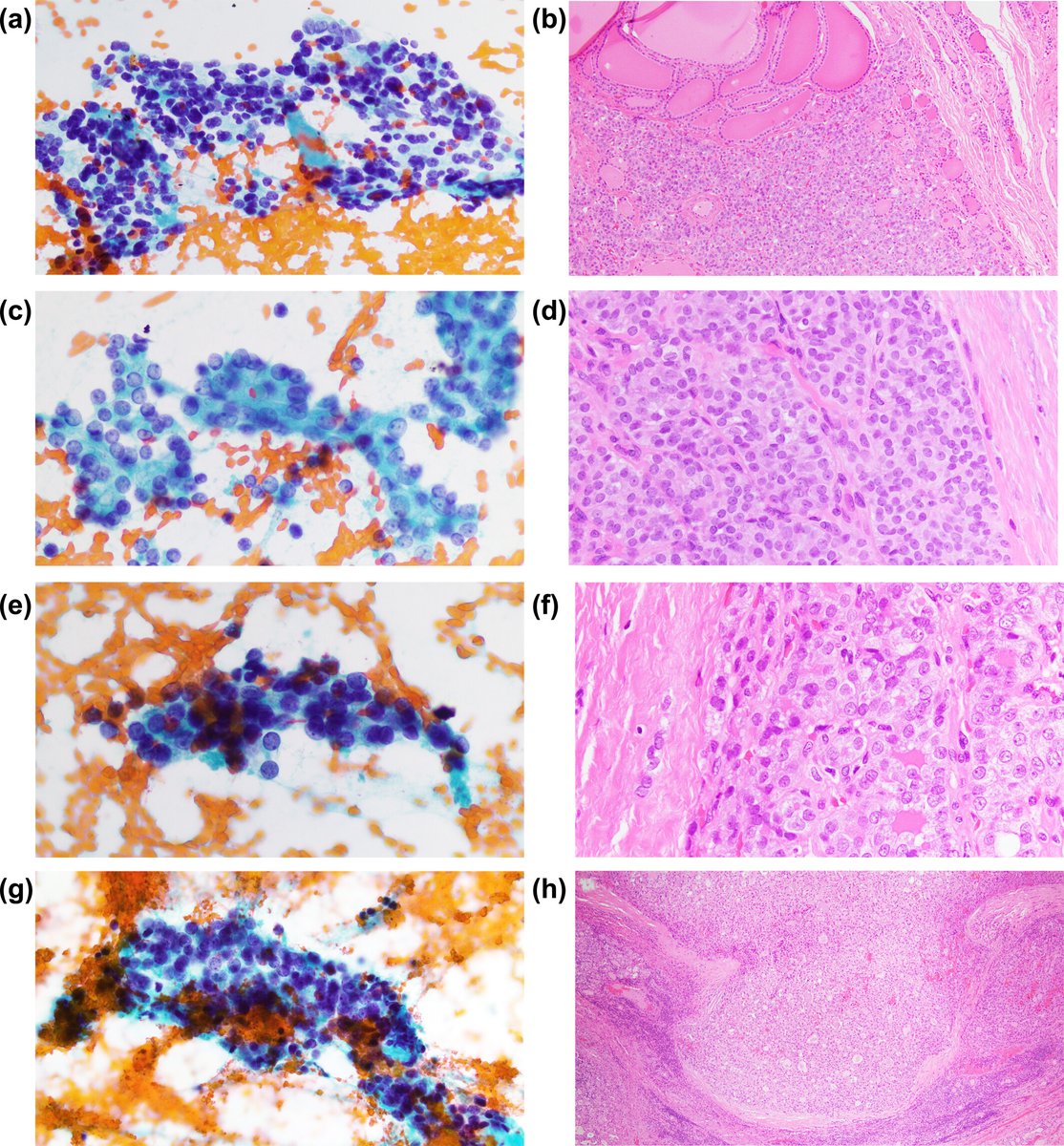 Cancer Cytopathology (@cancercytopath) on Twitter photo Thyroid nodules with DICER1 mutation or PTEN alteration: A comparative cytologic, clinical, and molecular study of 117 FNA cases
acsjournals.onlinelibrary.wiley.com/doi/full/10.10โฆ
<a href="/bfaquin/">WC Faquin, MD, PhD</a> <a href="/aakasharmand/">Zubair Baloch</a> #CytoPath Thyroid nodules with DICER1 mutation or PTEN alteration: A comparative cytologic, clinical, and molecular study of 117 FNA cases
acsjournals.onlinelibrary.wiley.com/doi/full/10.10โฆ
<a href="/bfaquin/">WC Faquin, MD, PhD</a> <a href="/aakasharmand/">Zubair Baloch</a> #CytoPath