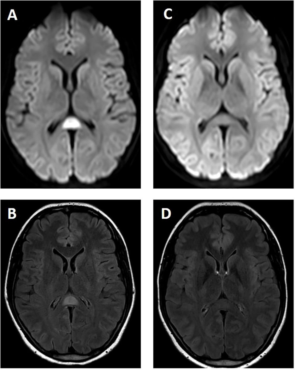 Brandon_Beaber's tweet photo. 27 year old woman with headache, fever, inattention, subtle psychosis 16 days after delivering a healthy child.  MRI showed THIS!  Diagnosis? https://t.co/4yGExEKh90