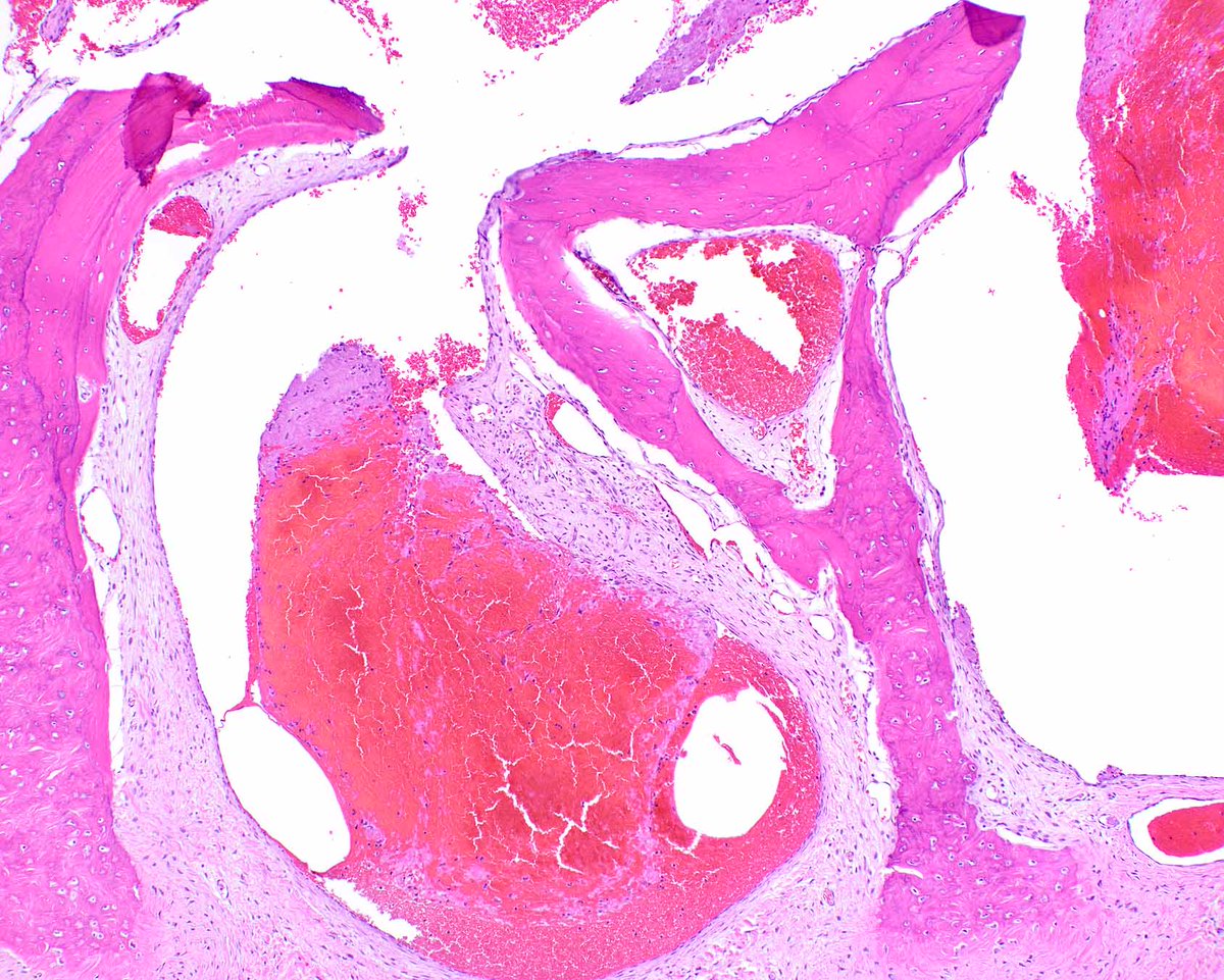 Hemangiomas can give a person a thick skull, although sometimes some of us have one anyway! #UMiamiPath
