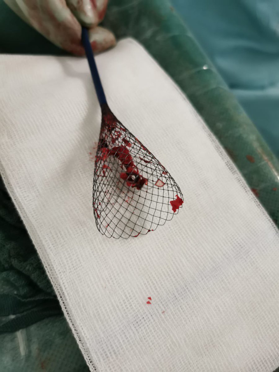 A small thrombus might cost you more than you think.