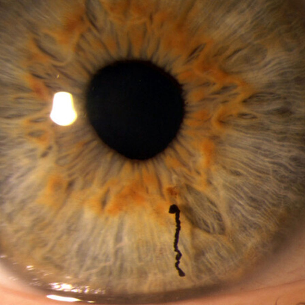 Uveitis #CME Webinar on 2/13. Join Dr. Brian Do, uveitis experts, and AUS to learn about the updates in local therapies for non-infectious #uveitis. Free for Academy members. ow.ly/ehrv50UIEzF