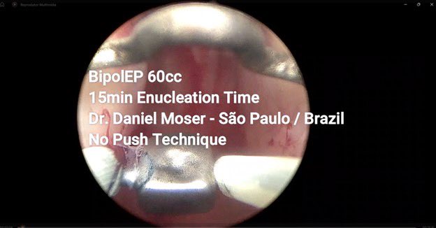 Daniel Moser 🇧🇷🇮🇹 (@moser_danielc) on Twitter photo #BipolEP: at least equivalent #AEEP #HoLEP
#BipolEP is a safe and also very fast alternative. Video of 60cc prostate with 15min enucleation time (no edition).
<a href="/Mohamedendourol/">Mohamed_omar</a> <a href="/lusuardi_lukas/">Lukas Lusuardi</a> <a href="/trwherrmann/">Thomas RW Herrmann</a> <a href="/lfredosanchez/">Alfredo Sanchez Urólogo</a> <a href="/endohugologo/">Hugo de la Rosa</a> <a href="/RomanCarvajal/">DR CARVAJAL</a>
youtu.be/WLNJNJVguEM?fe… #BipolEP: at least equivalent #AEEP #HoLEP
#BipolEP is a safe and also very fast alternative. Video of 60cc prostate with 15min enucleation time (no edition).
<a href="/Mohamedendourol/">Mohamed_omar</a> <a href="/lusuardi_lukas/">Lukas Lusuardi</a> <a href="/trwherrmann/">Thomas RW Herrmann</a> <a href="/lfredosanchez/">Alfredo Sanchez Urólogo</a> <a href="/endohugologo/">Hugo de la Rosa</a> <a href="/RomanCarvajal/">DR CARVAJAL</a>
youtu.be/WLNJNJVguEM?fe…