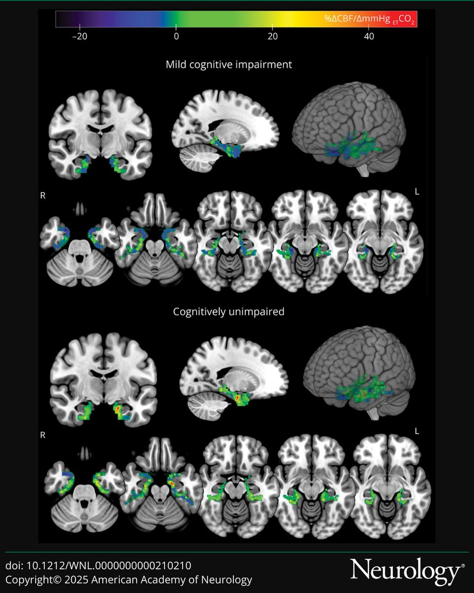 GreenJournal's tweet photo. This study examines the association of medial temporal lobe cerebrovascular reactivity and memory function in older adults with and without cognitive impairment: https://t.co/6CdKsYmiSB

#NeuroTwitter #NeuroX https://t.co/50HPGGuinX