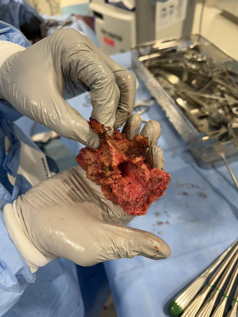 3 level thoracic en bloc spondylectomy in the Mayo Clinic cadaver lab today in preparation for performing this same surgery in a patient with chordoma. Proper prior planning prevents piss poor performance #SpineOncology
