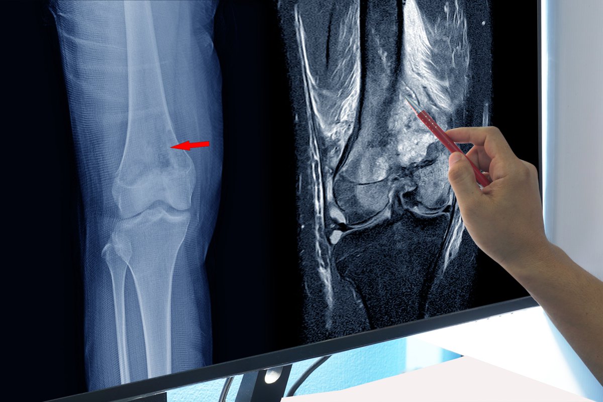 NewsMedical's tweet photo. 1/2. Strong heart, strong bones: How cardiovascular health influences bone density 🦴❤️📊 #BoneHealth #HeartHealth #Osteoporosis #Wellness #HealthyLiving #Prevention #Research #LE8 #Fitness #Health @SciReports https://t.co/JhrOKsOVI8