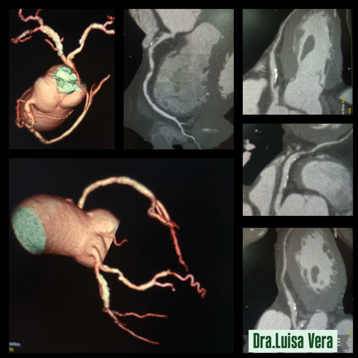 Enfermedad 3 vasos coronarios
#TCcardíaca #cardiovascular
#corazón #coronarias #heart
#radiology <a href="/radiologist/">radiologist</a> @TC