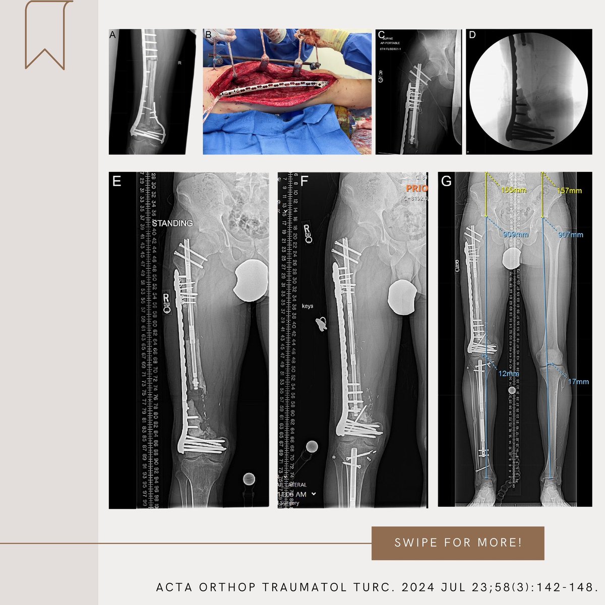 aottjournal's tweet photo. This review provides expert insights into solutions like expandable prostheses, biological reconstructions, and cutting-edge surgical techniques. Learn how multidisciplinary care is reshaping outcomes.
#LimbLength #Orthopaediconcology #BoneSarcoma #BoneTumor
#LimbSalvage https://t.co/hBfDNDwCLR