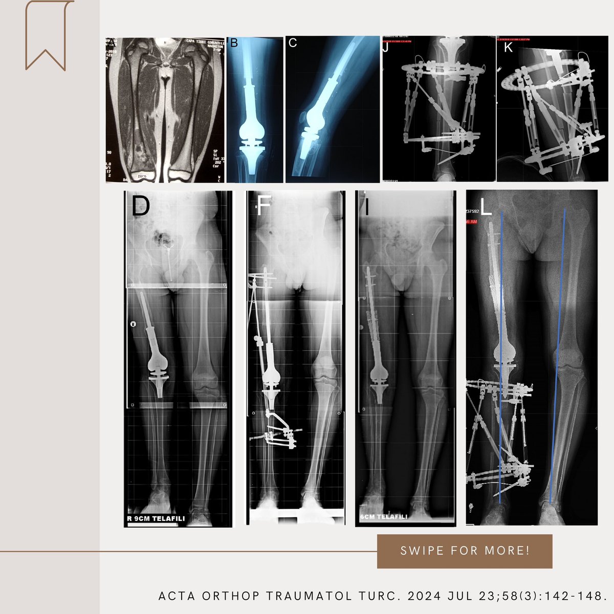aottjournal's tweet photo. This review provides expert insights into solutions like expandable prostheses, biological reconstructions, and cutting-edge surgical techniques. Learn how multidisciplinary care is reshaping outcomes.
#LimbLength #Orthopaediconcology #BoneSarcoma #BoneTumor
#LimbSalvage https://t.co/hBfDNDwCLR