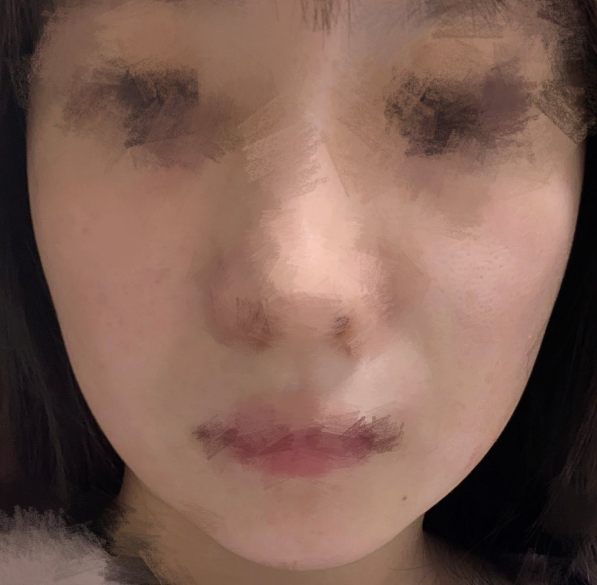 zeo0_0's tweet photo. 糸リフト12本
1枚目から
before→当日→次の日→5日目
ほうれい線もフェイスラインもあがって嬉しい🥺
ただ顔が大きく見える気がするんだけど、それでも今のが全然良いから何も問題ない😂
これで6万破格すぎる https://t.co/6f4OWlAhqR