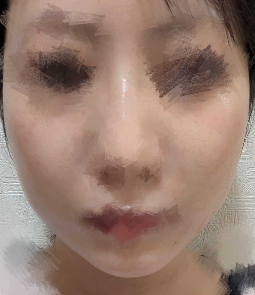 zeo0_0's tweet photo. 糸リフト12本
1枚目から
before→当日→次の日→5日目
ほうれい線もフェイスラインもあがって嬉しい🥺
ただ顔が大きく見える気がするんだけど、それでも今のが全然良いから何も問題ない😂
これで6万破格すぎる https://t.co/6f4OWlAhqR