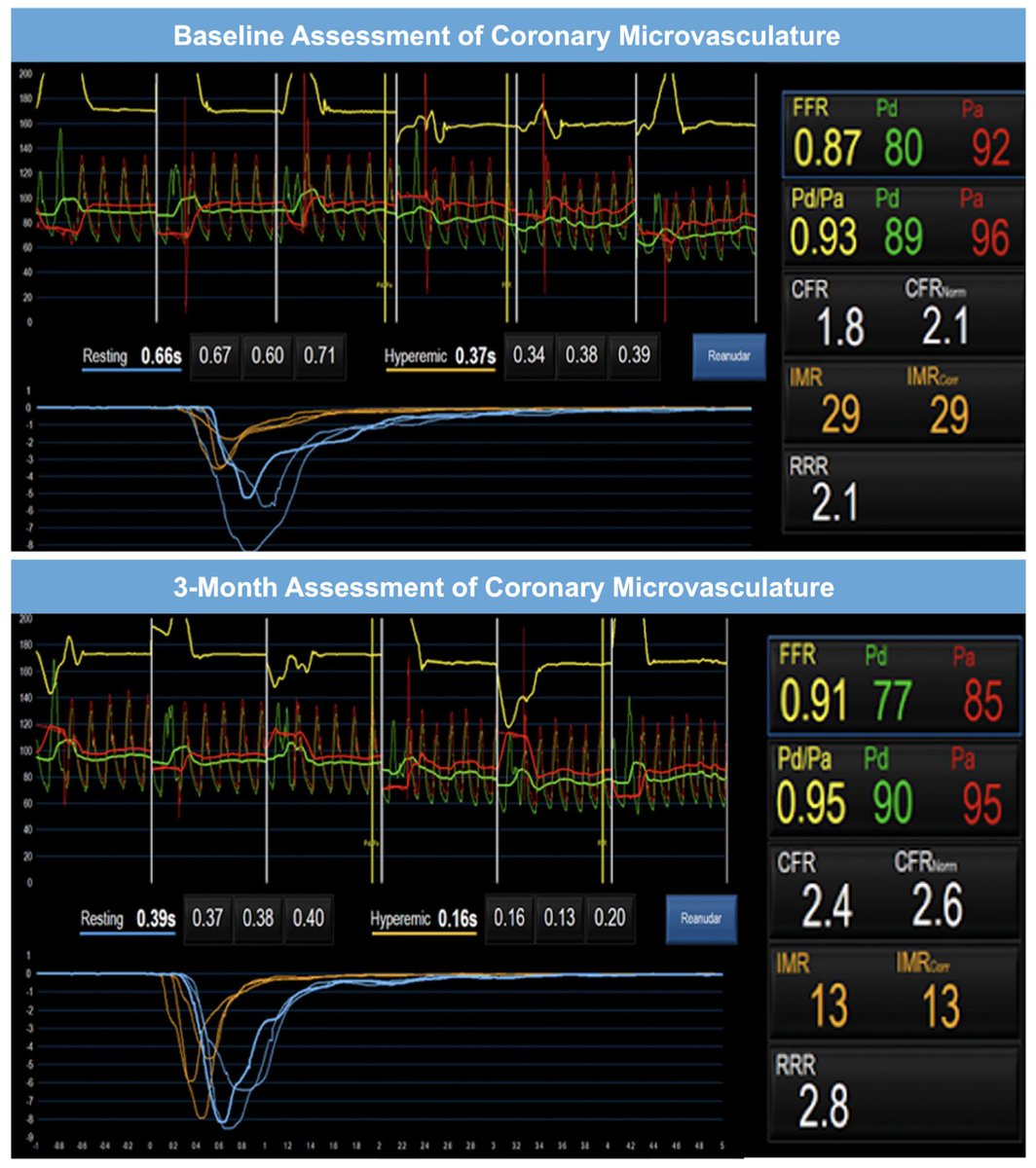 Salvatore Brugaletta (@sbrugaletta) on Twitter photo a single pt does not mean anything, but we may have a device-based treatment for microvascular angina. now it is 12M follow-up and the pt has fully recovered his quality of life. the evidence is growing. <a href="/PCRonline/">PCRonline 🫀</a> <a href="/crfheart/">Cardiovascular Research Foundation</a> <a href="/TCTMD/">TCTMD</a> <a href="/VijayKunadian/">Professor Vijay Kunadian</a> <a href="/GianlucaCampo78/">Gianluca Campo</a> <a href="/AntonioMariaLe2/">Antonio Maria Leone</a> a single pt does not mean anything, but we may have a device-based treatment for microvascular angina. now it is 12M follow-up and the pt has fully recovered his quality of life. the evidence is growing. <a href="/PCRonline/">PCRonline 🫀</a> <a href="/crfheart/">Cardiovascular Research Foundation</a> <a href="/TCTMD/">TCTMD</a> <a href="/VijayKunadian/">Professor Vijay Kunadian</a> <a href="/GianlucaCampo78/">Gianluca Campo</a> <a href="/AntonioMariaLe2/">Antonio Maria Leone</a>