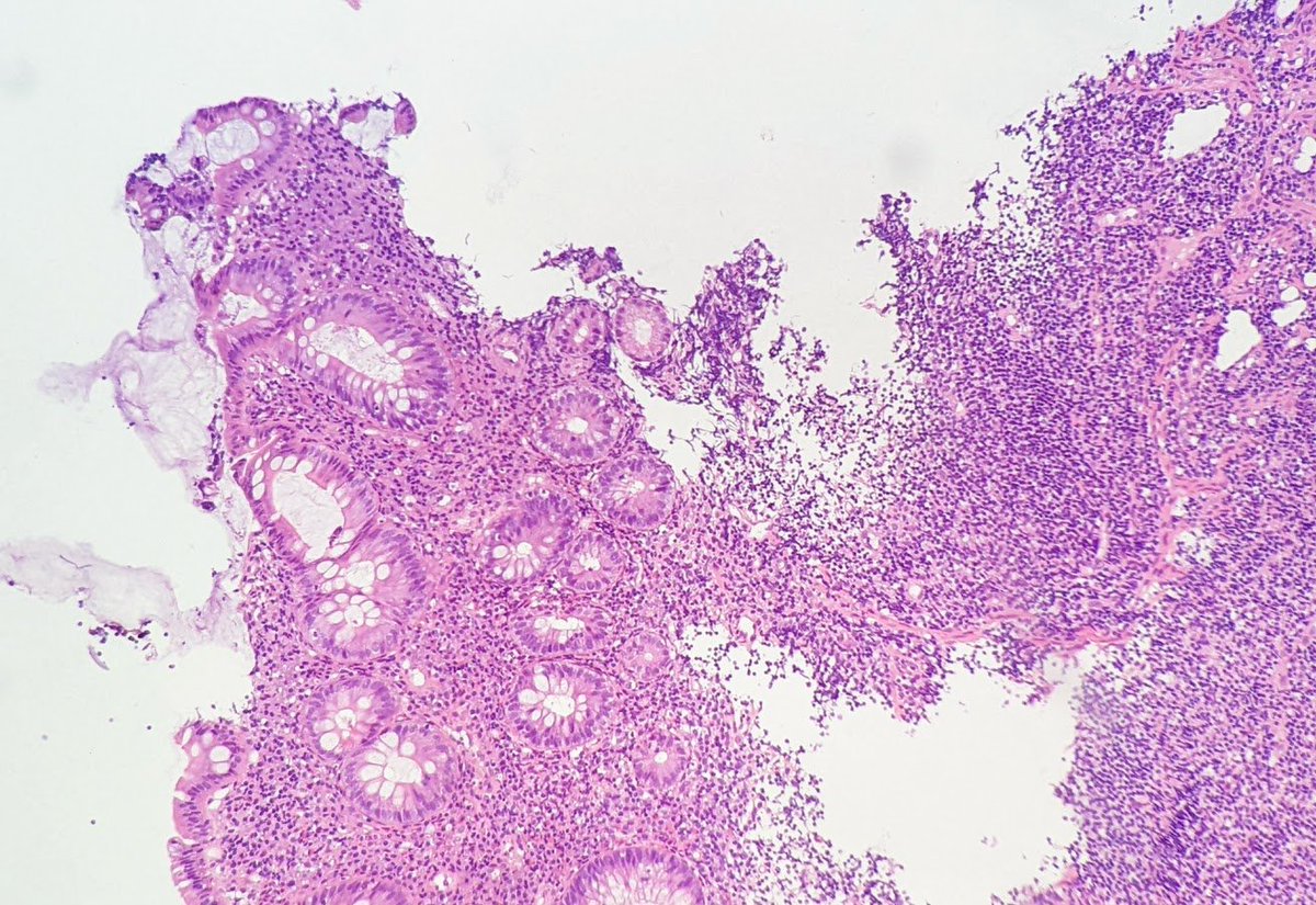 YarisDombrovsky's tweet photo. #PathTwitter #Gipath #gipsoc @IHC_guy @RAStandish @emma_furth @stephen_lagana
Can I sell this as a pyloric mtpl to you🙃? Ileum, m30yo https://t.co/gnQBQ0Fuop