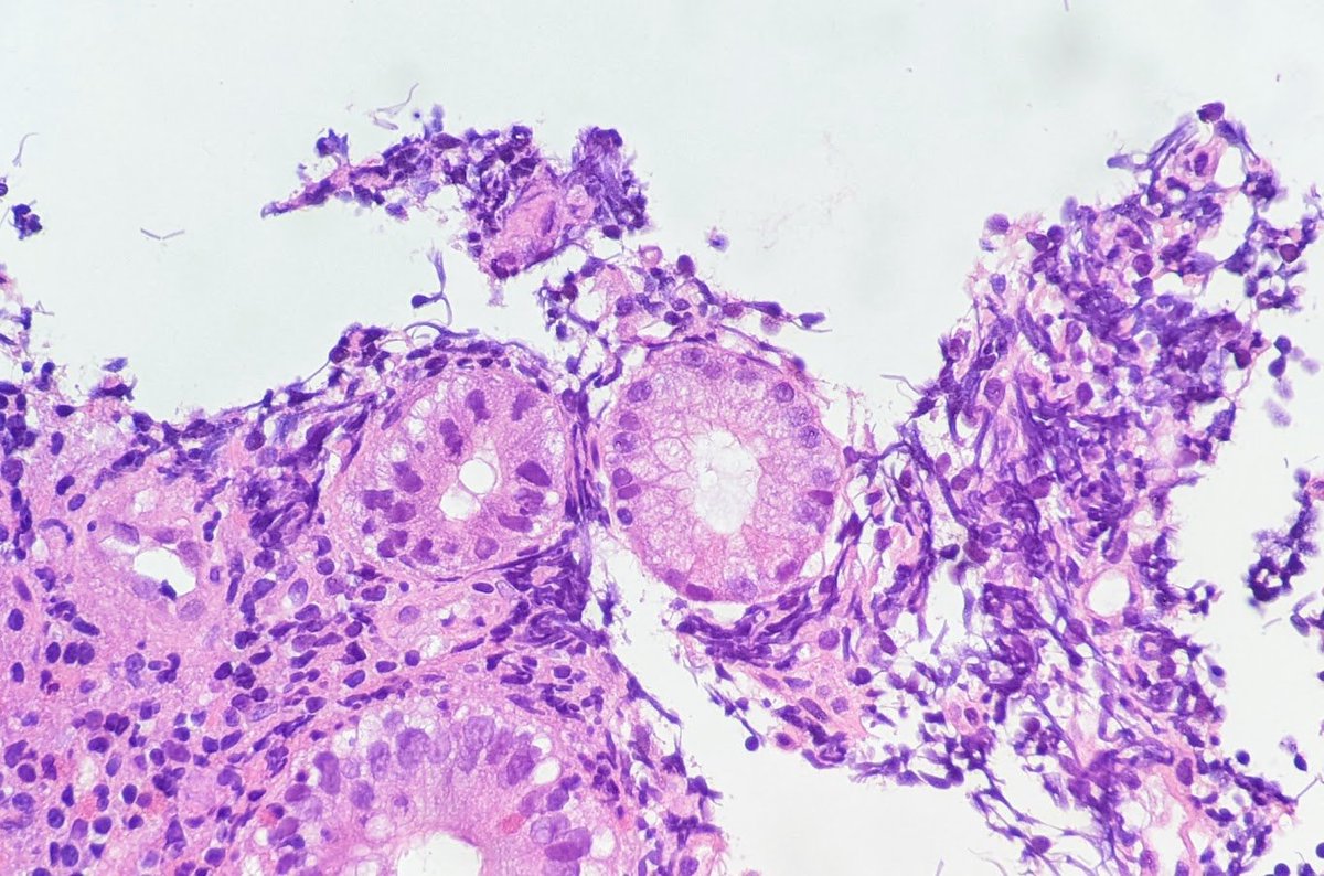 YarisDombrovsky's tweet photo. #PathTwitter #Gipath #gipsoc @IHC_guy @RAStandish @emma_furth @stephen_lagana
Can I sell this as a pyloric mtpl to you🙃? Ileum, m30yo https://t.co/gnQBQ0Fuop