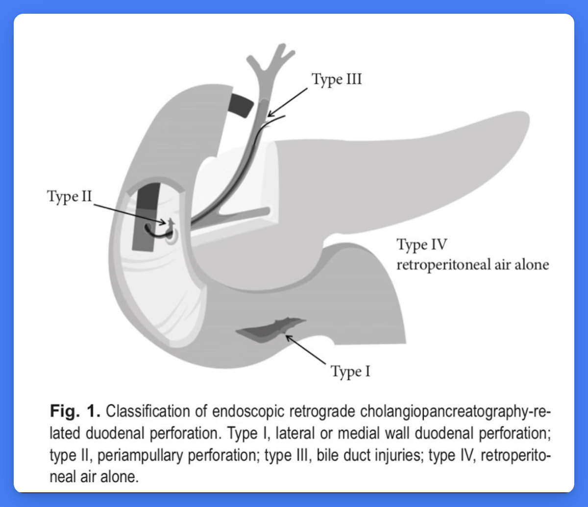 EndoCollabcom's tweet photo. Here's a helpful visual guide to the different types of duodenal perforations that can occur during ERCP.

The classification ranges from Type I (duodenal wall) to Type IV (retroperitoneal air only).

Knowing the type helps guide whether endoscopic, surgical, or conservative management is most appropriate.

What are your preferred endoscopic techniques for managing Type II perforations?

Share your expertise and learn more on https://t.co/wCqmXAw9oN