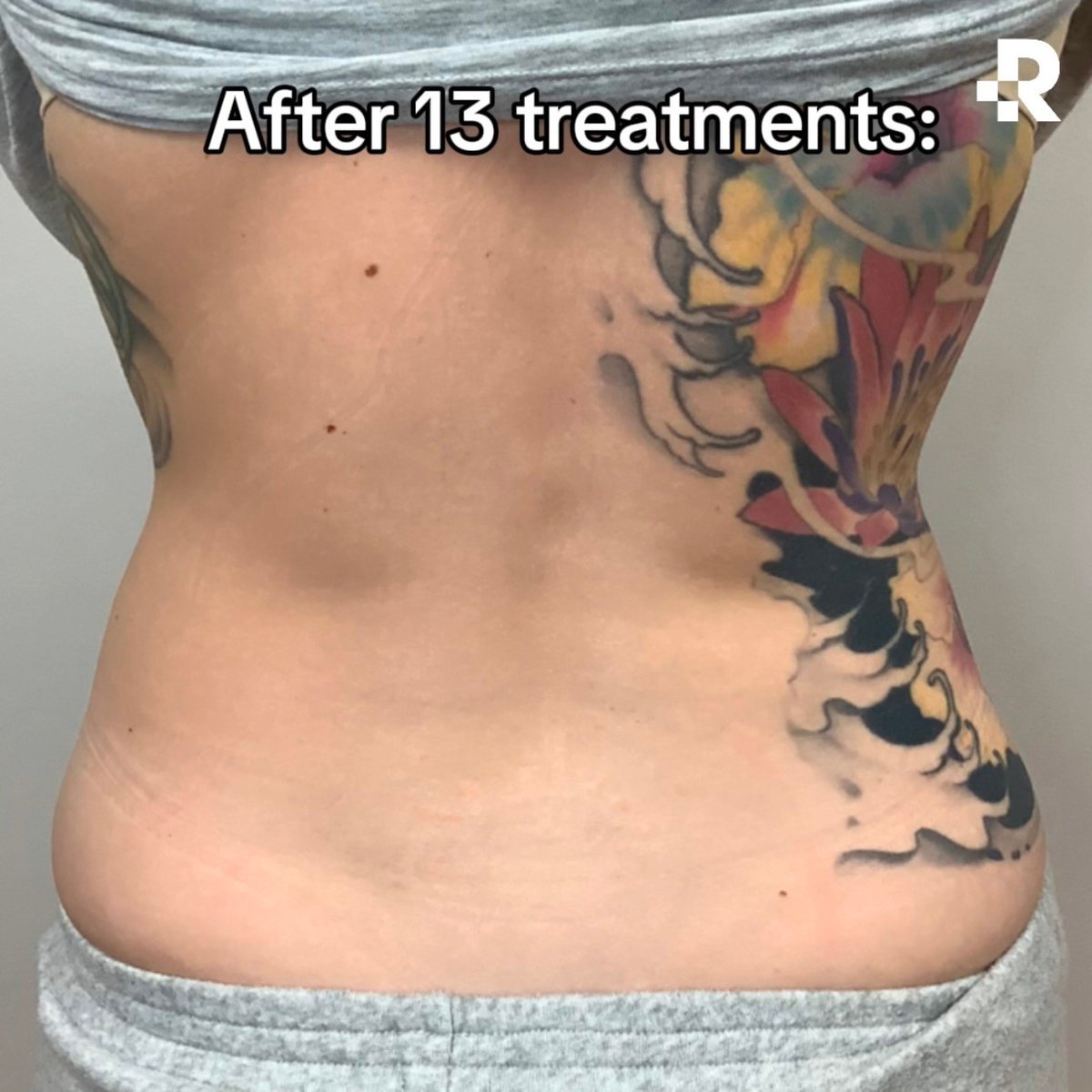 CandelaMedical1's tweet photo. Once again #Removery proving their expertise at tattoo removal and why they chose PicoWay® as their laser of choice across their entire estate of more than 150 clinics
With 4 true picosecond-wavelengths, PicoWay can clear tattoo ink in fewer sessions &amp; less time than other lasers https://t.co/YyEqLDTSIw