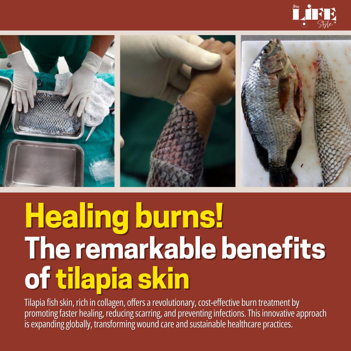 dailystarnews's tweet photo. Read more here: https://t.co/2hD9GRV30u
#BurnTreatment #TilapiaSkin #MedicalInnovation #AdvancedHealing #CollagenTherapy #WoundCare #AffordableHealthcare #BurnRecovery #InfectionPrevention #TissueRegeneratio https://t.co/Fd1Rr914KR