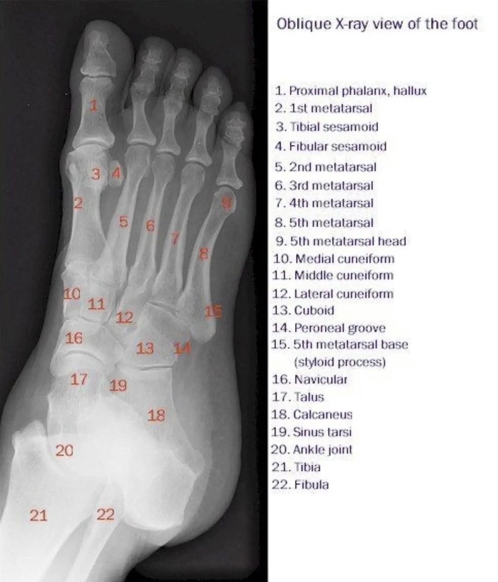 AbdullahNMT's tweet image. اناتومي القدم في الأشعة السينية 🩻
#X_ray of the foot (Anatomy) 🩻
Oblique