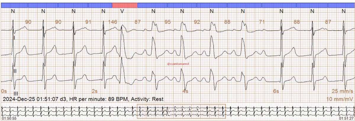 An interesting Holter. What is likely happening here?
#Epeeps