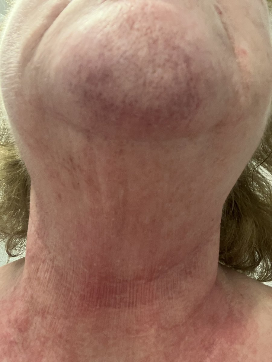 mariemiskelly's tweet photo. @qvcuk @AliYoungBeauty I bought Skinsense TSV. I was so looking forward to using it. I cleansed and put the night cream on and woke up like this the next day . I don’t know what was in the formula for my neck to react like that https://t.co/xJwmpZVuha
