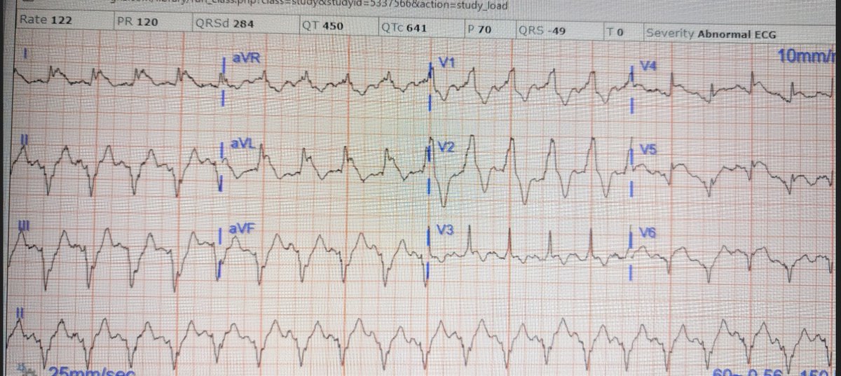 Stephen W. Smith (@smithecgblog) on Twitter photo One of those ECGs you need to instantly recognize, which learners may struggle with at first
hqmeded-ecg.blogspot.com/2025/01/one-of…
<a href="/PendellM/">Pendell Meyers</a> One of those ECGs you need to instantly recognize, which learners may struggle with at first
hqmeded-ecg.blogspot.com/2025/01/one-of…
<a href="/PendellM/">Pendell Meyers</a>