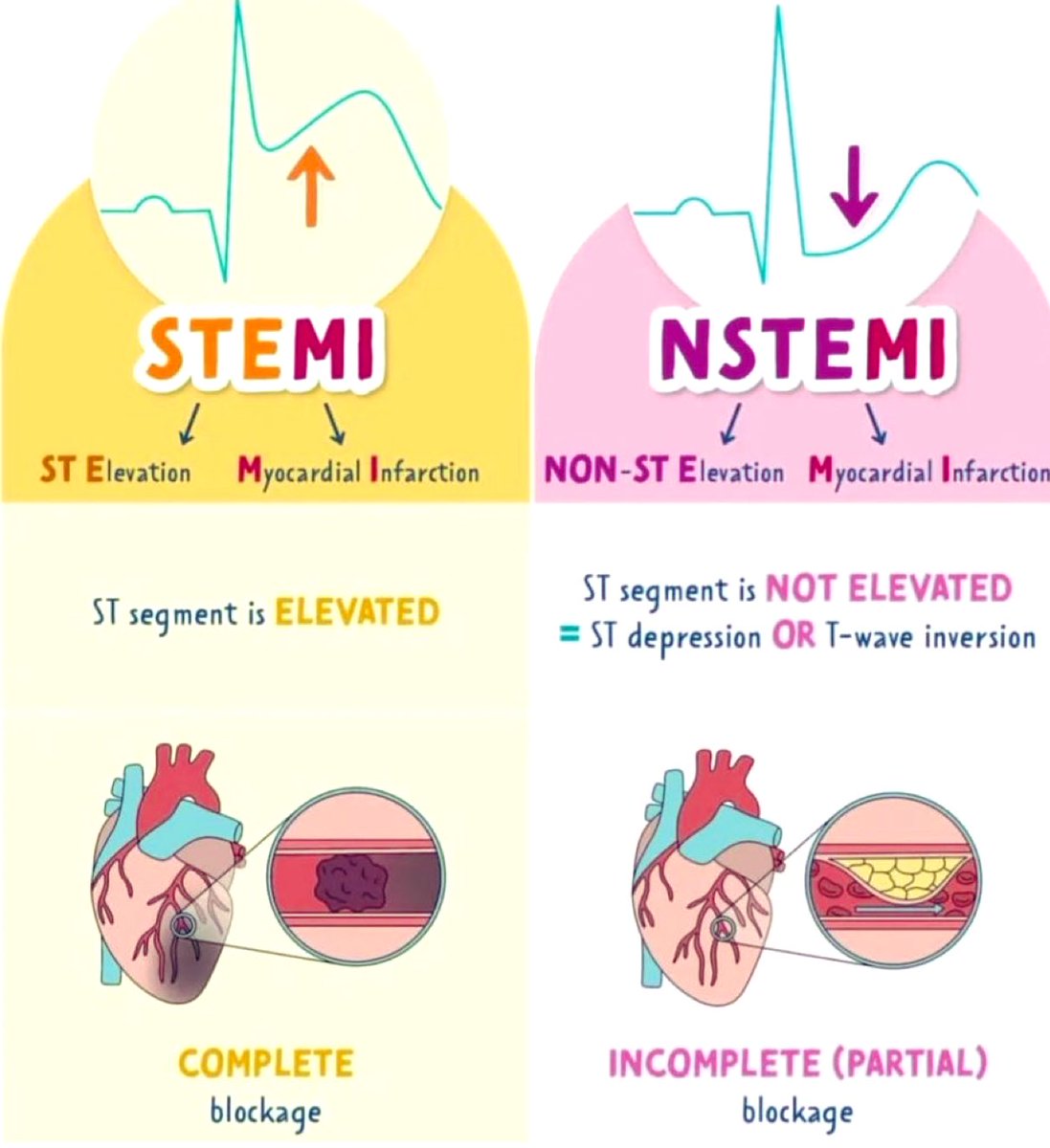 DrPharmDMDTh's tweet photo. STEMI vs NSTEMI https://t.co/WIkhH6l3FQ