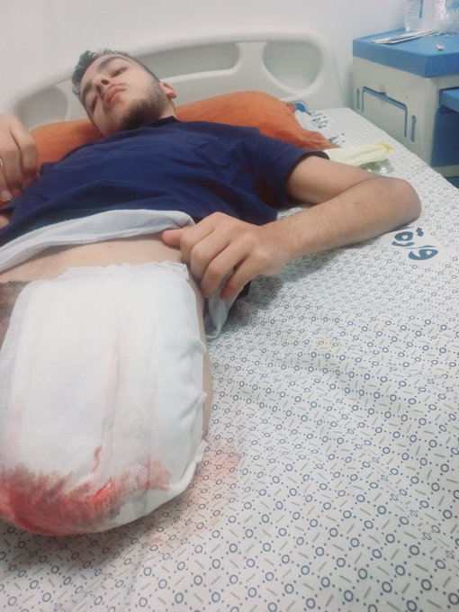 qs4rr's tweet photo. I’m deeply sad😞I’ve lost my🦵&amp; due to a lack of food &amp; medicines, my wound has worsened😭Thousands are seeing my posts, but no one is donating💔

Please show your humanity‼️
 i'm very Sick &amp; in pain😭please pray for me
🔗 https://t.co/RyUVeylsFq https://t.co/qkgayUvXNz