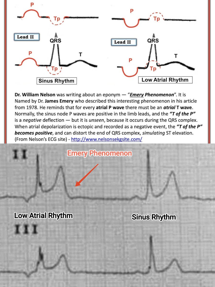 As Everyone said This One Is Low Atrial Rhythm and Cause ST Elevation due To Emery Phenomenon

Noted ST Segment Elevation Seen in Red Arrow During Low Atrial Beat Rhythm Compared To ST Segment In Normal Sinus Rhythm

I like This ECG because Direct Comparison of ST Segment Between