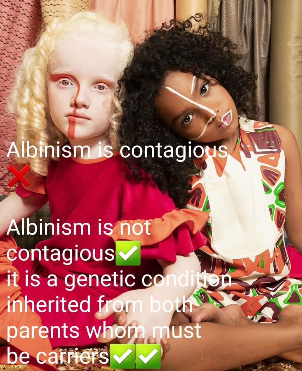 #SameAsYou #changingthenarrative #HelpmeCross #Golden #BreakingtheLabel #Albino #AlbinismAwareness #Albinism #PWA