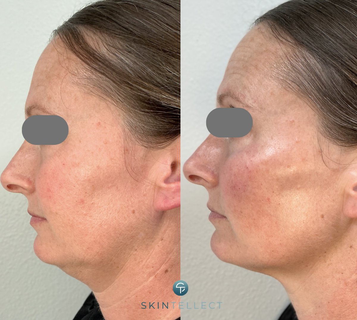SkintellectTPA's tweet photo. ✨ Incredible transformation with 3.5 syringes of filler! 

#CheekLift #UndereyeRejuvenation #ChinTightening #FacialVolumeRestoration #YouthfulGlow #BeforeAndAfter #NonSurgicalLift #MedSpaTampa #DermalFillers #AestheticEnhancement https://t.co/DqB89cptBm