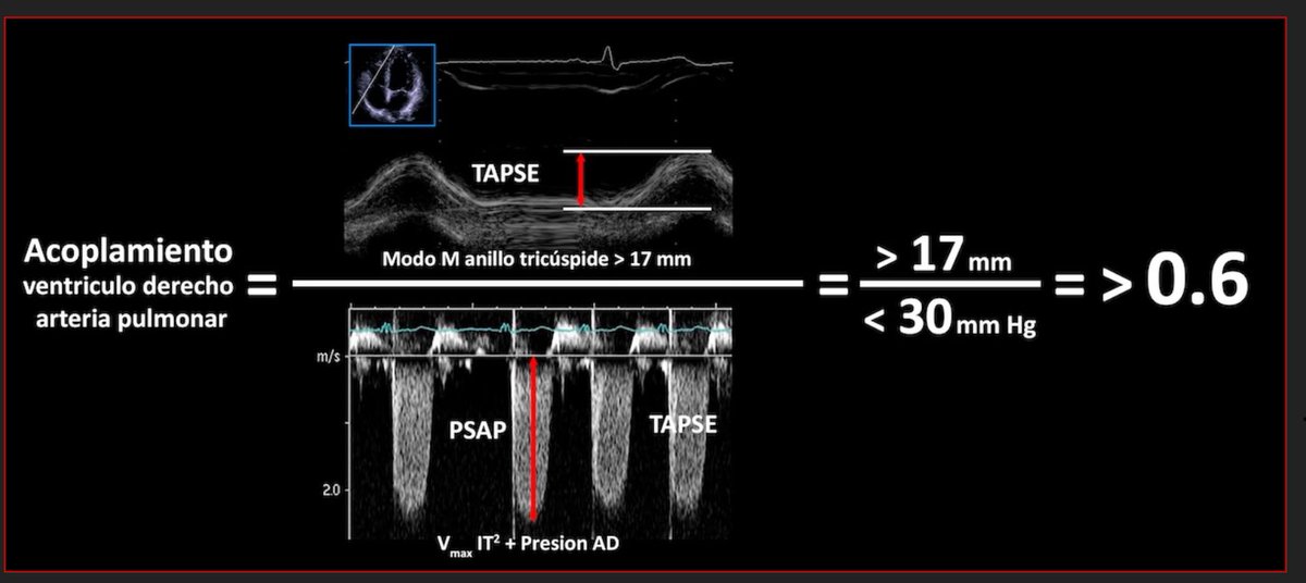 RevistaRetic (@revistaretic) on Twitter photo Aprende a medir el acoplamiento ventrículo derecho /Arteria pulmonar.
Una fácil trukipedia de <a href="/josejgdnews/">Jose Juan Gomez</a> y <a href="/MAecocardio/">MA Garcia Fernandez</a> te pone fácil como hacerlo en buff.ly/4a9soZf Aprende a medir el acoplamiento ventrículo derecho /Arteria pulmonar.
Una fácil trukipedia de <a href="/josejgdnews/">Jose Juan Gomez</a> y <a href="/MAecocardio/">MA Garcia Fernandez</a> te pone fácil como hacerlo en buff.ly/4a9soZf