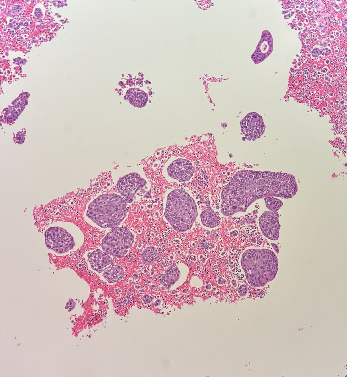 israhkhan's tweet photo. #breastcyto #breastpath
First time dx :breast cancer presenting as a Pleural effusion.Classic cannon ball formation of tumor cells, GATA-3 positive and HER -2 score 3 +ER/PR-
Waiting for TRPS-1 Mammogram is trirad 3 ,prev bx (long time back) neg
#cytorocks clinician wants bx https://t.co/Ufe6C7Dz3y