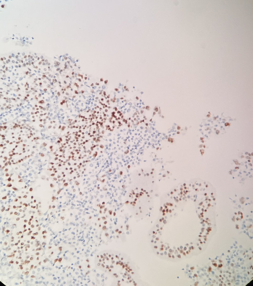 israhkhan's tweet photo. #breastcyto #breastpath
First time dx :breast cancer presenting as a Pleural effusion.Classic cannon ball formation of tumor cells, GATA-3 positive and HER -2 score 3 +ER/PR-
Waiting for TRPS-1 Mammogram is trirad 3 ,prev bx (long time back) neg
#cytorocks clinician wants bx https://t.co/Ufe6C7Dz3y