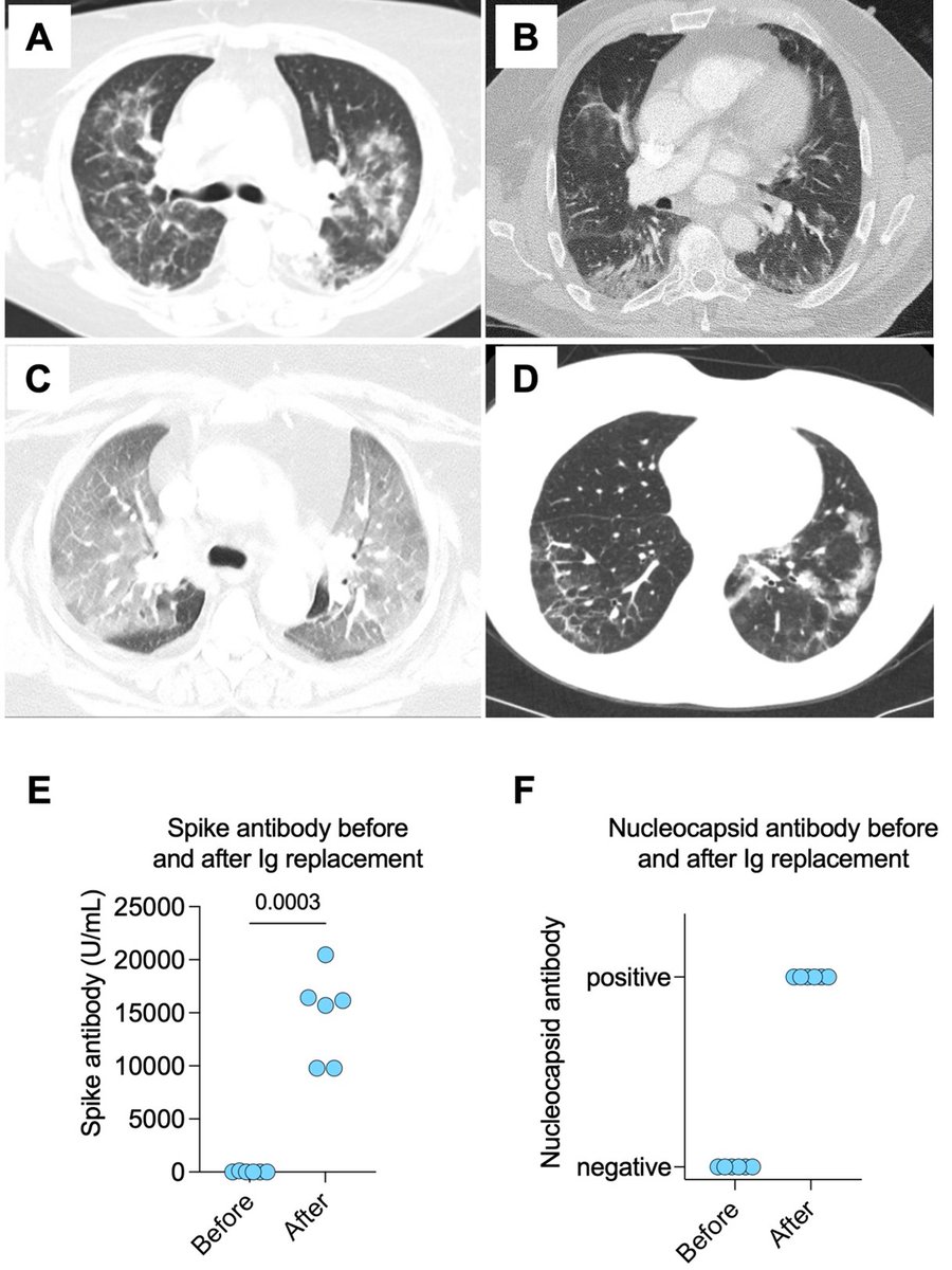 Orhan Efe (@orhanefe_) on Twitter photo 🚨Our paper out🚨
B cell-depletion cause a unique risk of protracted COVID-19
-Often misdiagnosed
-Sputum/bronch samples are key
-Extended antivirals+IVIG r effective
doi.org/10.1093/rheuma…
G.Sauvage,J.Chung,A.Jeyabalan, <a href="/AlJurdi/">Ayman Al Jurdi, MD FASN</a> <a href="/BetterCallSeeth/">Harish Seethapathy</a> K.Laliberte,J.Niles
@MGHKidneys 🚨Our paper out🚨
B cell-depletion cause a unique risk of protracted COVID-19
-Often misdiagnosed
-Sputum/bronch samples are key
-Extended antivirals+IVIG r effective
doi.org/10.1093/rheuma…
G.Sauvage,J.Chung,A.Jeyabalan, <a href="/AlJurdi/">Ayman Al Jurdi, MD FASN</a> <a href="/BetterCallSeeth/">Harish Seethapathy</a> K.Laliberte,J.Niles
@MGHKidneys
