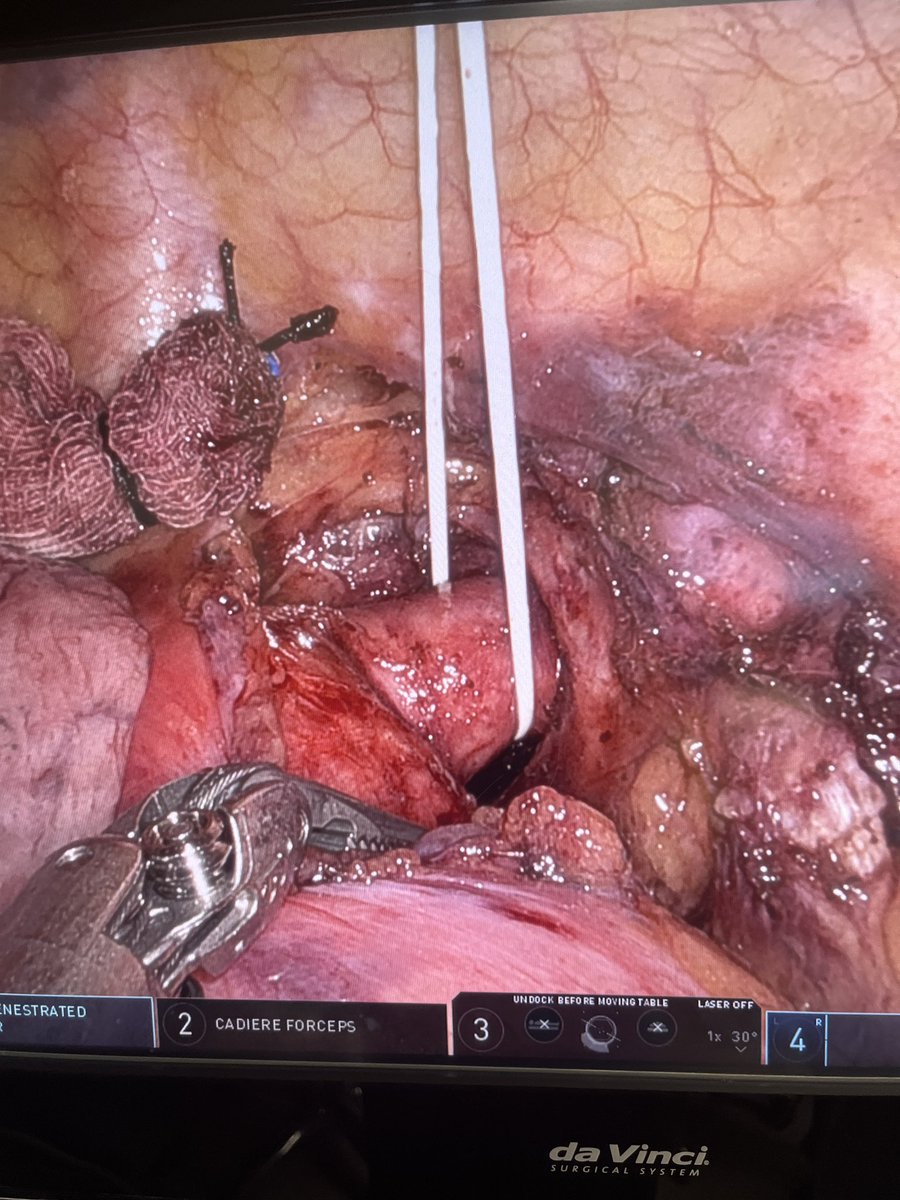JHH Vascular Surgery (@jhhvascular) on Twitter photo Robotic vascular surgery at <a href="/JHHVascular/">JHH Vascular Surgery</a> and <a href="/HopkinsCTSurg/">Johns Hopkins Cardiothoracic Surgery</a> ! Robotic ligation of aberrant right subclavian artery for management of dysphasia lusoria. #roboticvascular Robotic vascular surgery at <a href="/JHHVascular/">JHH Vascular Surgery</a> and <a href="/HopkinsCTSurg/">Johns Hopkins Cardiothoracic Surgery</a> ! Robotic ligation of aberrant right subclavian artery for management of dysphasia lusoria. #roboticvascular