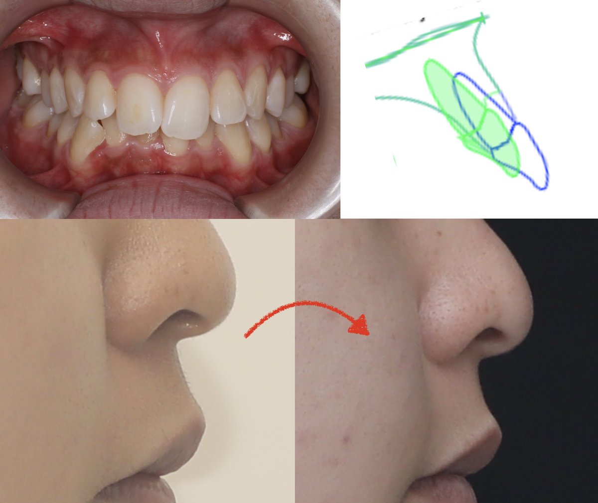 dds_cozy's tweet image. 前歯が出ている
のを主訴に来院された時に、
抜歯して単純に下げない理由が、この感じ。

この症例を抜歯して下げるだけだと、
人中伸びて面長感が出て、
俗に
「本人は失敗と感じてるが、矯正は成功」
となりがち。