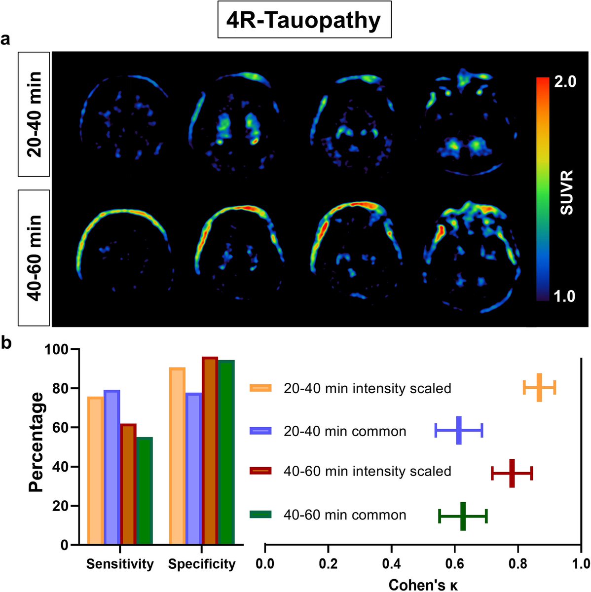 Nico Franzmeier (@nfranzme) on Twitter photo Happy to share our new work led by <a href="/JGnorich/">Johannes Sebastian Gnörich</a> and <a href="/matbrendel/">MatthiasBrendel</a>, suggesting a visual read algorithm for PI-2620 in 4R taupathies. Early imaging windows, kinetic modelling and basal ganglia are key!
doi.org/10.1016/j.neur… Happy to share our new work led by <a href="/JGnorich/">Johannes Sebastian Gnörich</a> and <a href="/matbrendel/">MatthiasBrendel</a>, suggesting a visual read algorithm for PI-2620 in 4R taupathies. Early imaging windows, kinetic modelling and basal ganglia are key!
doi.org/10.1016/j.neur…