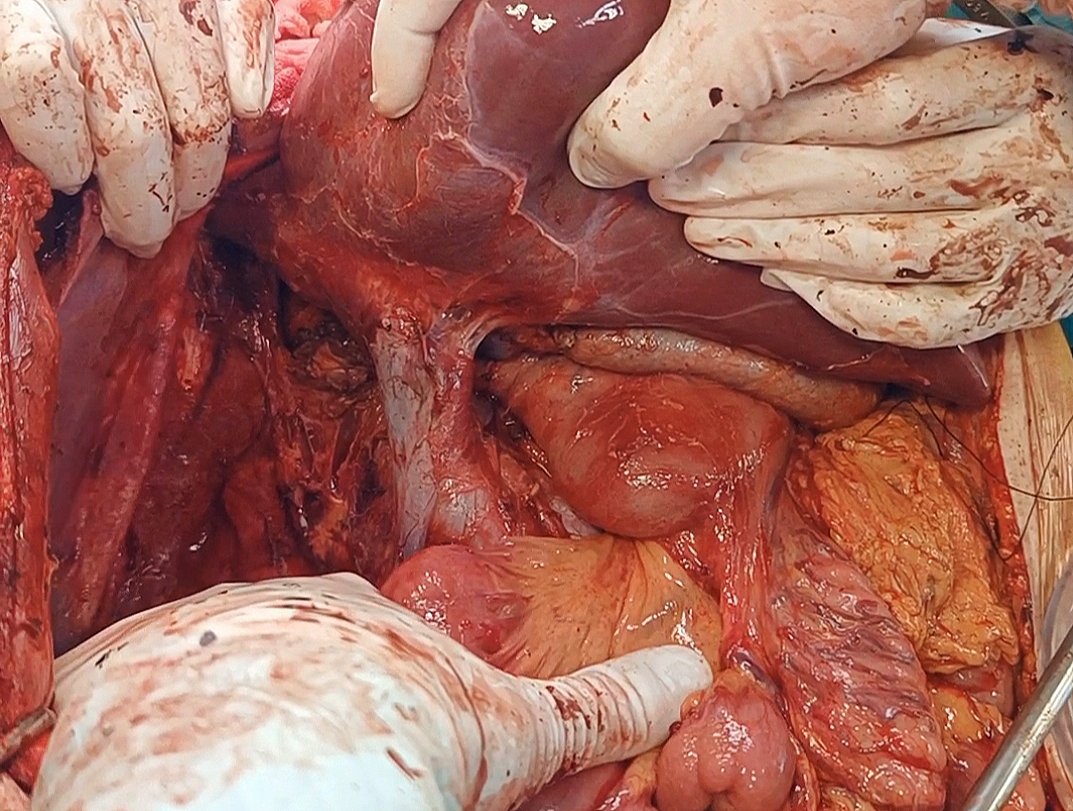 IvanVella91's tweet photo. Pushing the limits in DBD donor #liver procurement, minimizing #donor WIT and backtable.
A great opportunity to improve #surgical #skills. 
And why not ? Perhaps this technique represents the starting point that will lead us to #ischemiafree harvesting ? https://t.co/hkFjAqaZN9