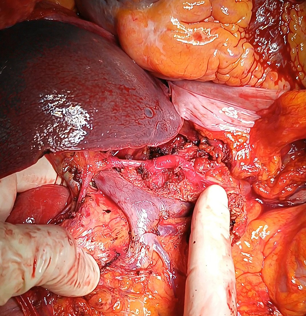 IvanVella91's tweet photo. Pushing the limits in DBD donor #liver procurement, minimizing #donor WIT and backtable.
A great opportunity to improve #surgical #skills. 
And why not ? Perhaps this technique represents the starting point that will lead us to #ischemiafree harvesting ? https://t.co/hkFjAqaZN9