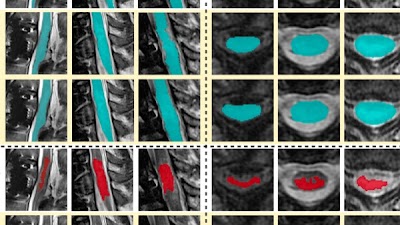 Radiology_AI's tweet photo. #SCIseg accurately segmented intramedullary lesions on a diverse dataset of T2-w MRIs https://t.co/aWdpQeHTEN @naga_karthik7 @DrAndrewCSmith @DrKenWeber #DeepLearning #MSKRad #ML https://t.co/5fwIap3vBp
