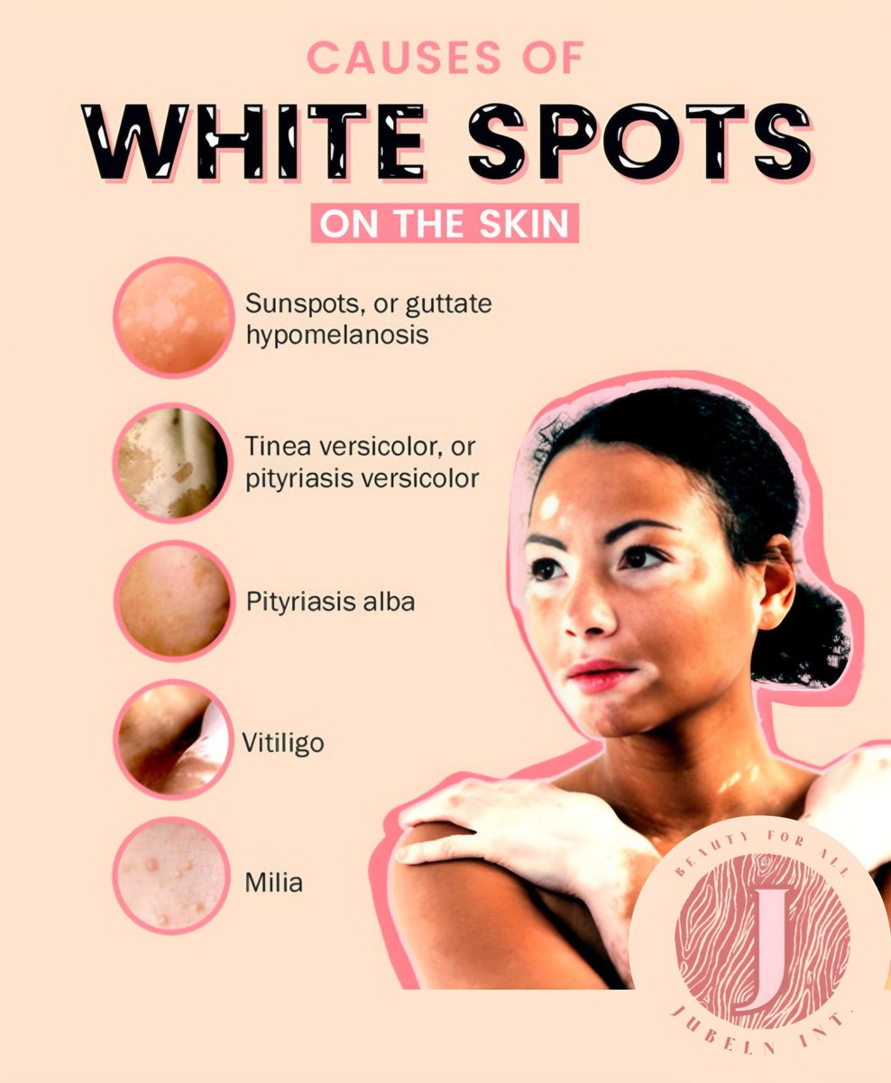 JUBELNNEWS's tweet photo. When skin proteins or dead cells are stuck beneath the skin's surface, white age spots on the skin frequently result. These could also be brought on by conditions like colour loss or depigmentation.
 #personalcare #beauty #jubelninternational #cosmetics #whitespotscauses https://t.co/CDthtz1Zfw