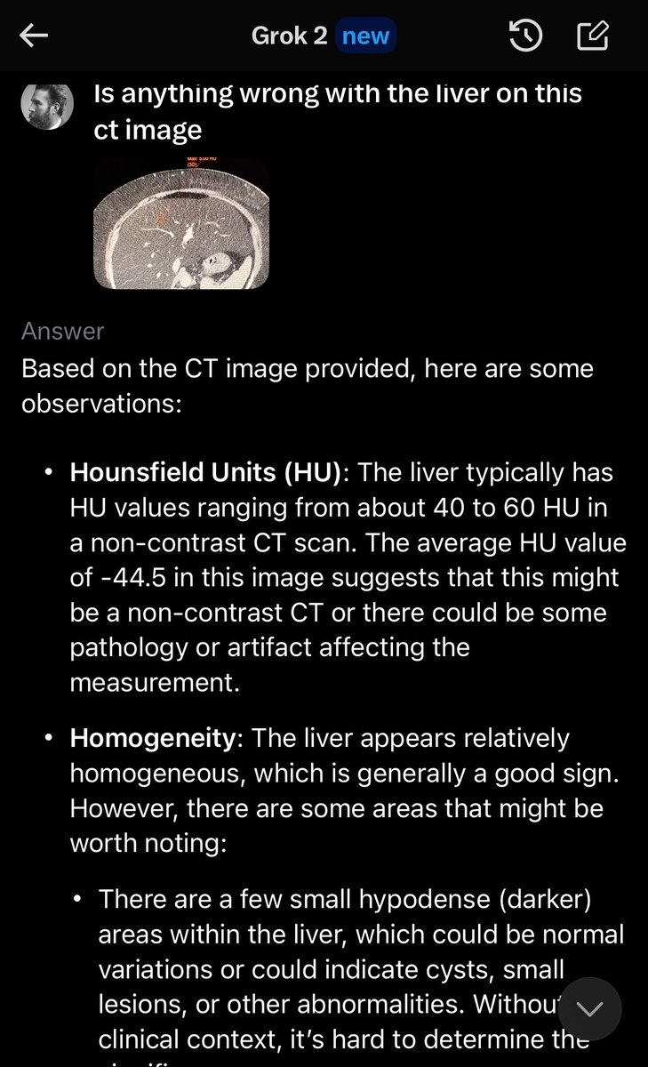 Wil (@willyrontgen) on Twitter photo Asked Grok if there was anything wrong with the liver in this image. No mention of steatosis, hallucinated liver cysts, and incorrectly identified the study as a noncon exam. <a href="/drsxr/">Stephen Borstelmann MD</a> <a href="/woojinrad/">Woojin Kim</a> <a href="/heacockmd/">Laura Heacock, MD</a> <a href="/northwoods1980/">RJ</a> #GrokErrors #GrokRadiologyFail #LLMFail Asked Grok if there was anything wrong with the liver in this image. No mention of steatosis, hallucinated liver cysts, and incorrectly identified the study as a noncon exam. <a href="/drsxr/">Stephen Borstelmann MD</a> <a href="/woojinrad/">Woojin Kim</a> <a href="/heacockmd/">Laura Heacock, MD</a> <a href="/northwoods1980/">RJ</a> #GrokErrors #GrokRadiologyFail #LLMFail