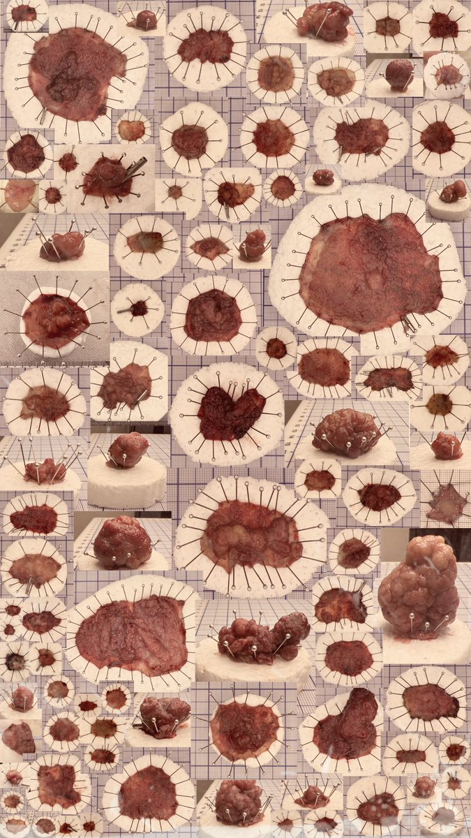 ben_sukit's tweet photo. So many colon polyps I resected in 2024. In my opinion, ESD is a fascinating procedure with beautiful results. #ColonPolyp #ESD #EndoscopicSubmucosalDissection https://t.co/81aDtv1epi