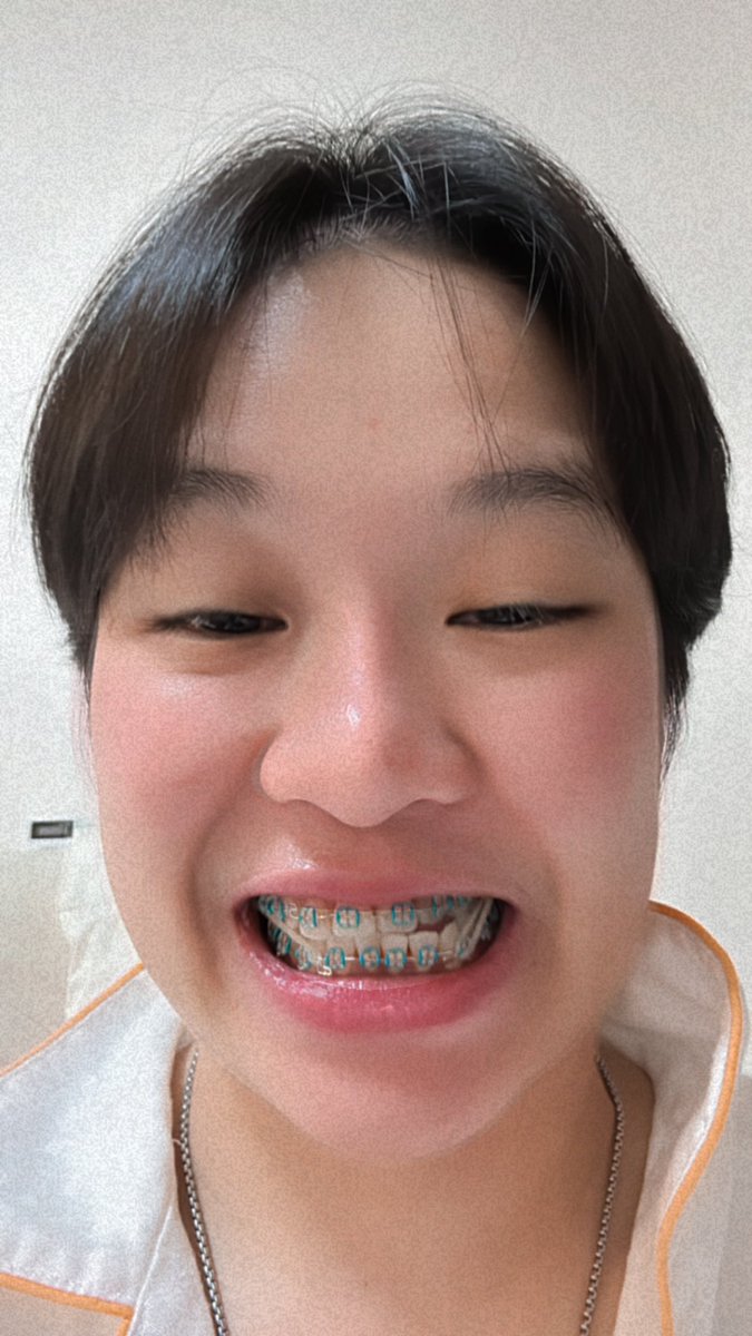 num_natdarat's tweet photo. จัดฟันเดือนที่ 4 😁 #cs矯正歯科クリニック#矯正#ニュージルコニア#歯列矯正 https://t.co/bIO8ihQWDT