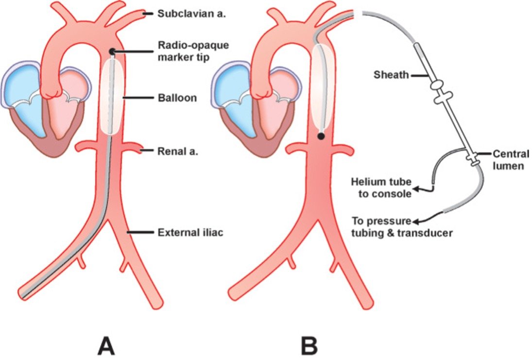 Aakash Tuli (@aakashtulimd) on Twitter photo 🚨 IABP 101: A Comprehensive #Tweetorial #MedEd #CardioX 🚨
<a href="/ACCinTouch/">American College of Cardiology</a> <a href="/CCCEnthusiasts/">CCC Enthusiasts</a>
Let’s discuss Intra-Aortic Balloon Pump (IABP) – its uses, mechanisms, contraindications, when to use vs inotropes/vasopressors, and landmark trials. 🩺🫀
🖼️: mmcts.org/tutorial/1942 🚨 IABP 101: A Comprehensive #Tweetorial #MedEd #CardioX 🚨
<a href="/ACCinTouch/">American College of Cardiology</a> <a href="/CCCEnthusiasts/">CCC Enthusiasts</a>
Let’s discuss Intra-Aortic Balloon Pump (IABP) – its uses, mechanisms, contraindications, when to use vs inotropes/vasopressors, and landmark trials. 🩺🫀
🖼️: mmcts.org/tutorial/1942