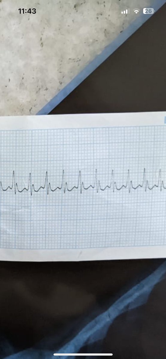 AnotherMadico's tweet photo. @sumersethi Yes sir, Grok couldn’t correctly calculate the heart rate from the ECG. An HR of around 300bpm was misinterpreted as only 70bpm. Then it was too arrogant to accept the mistake even after multiple explanations from my end. ChatGPT however gave the correct response. https://t.co/sBpBbNhWED